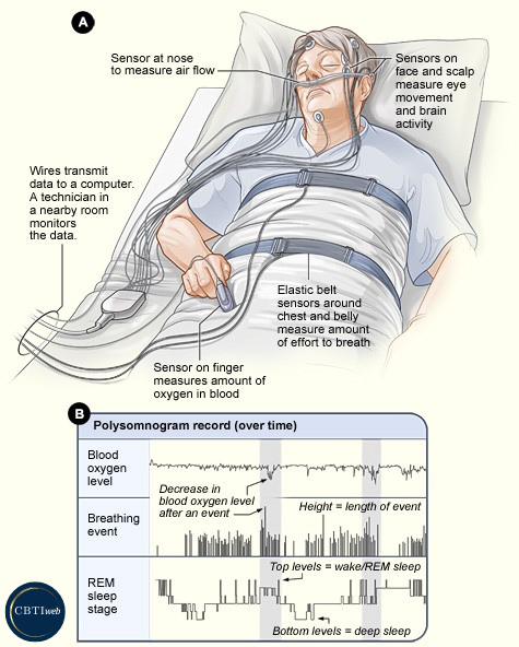Assessment - Visual of PSG
